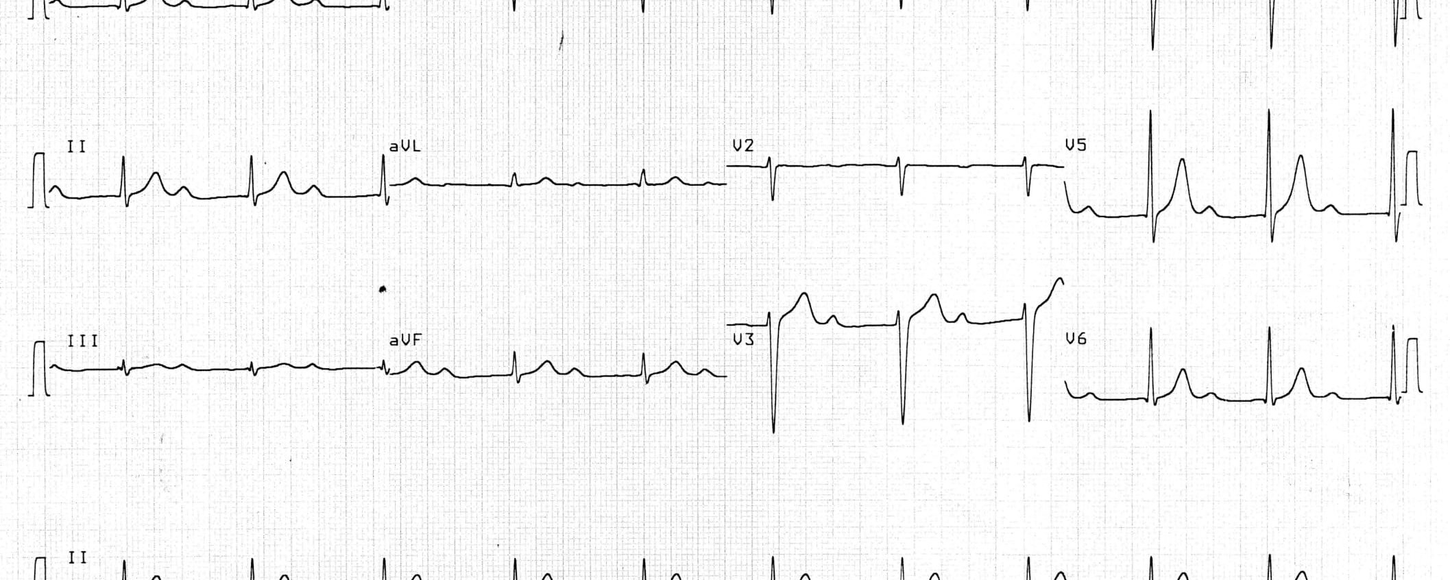 Mijn ECG